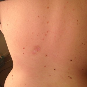 scar-on-back-1-year-post