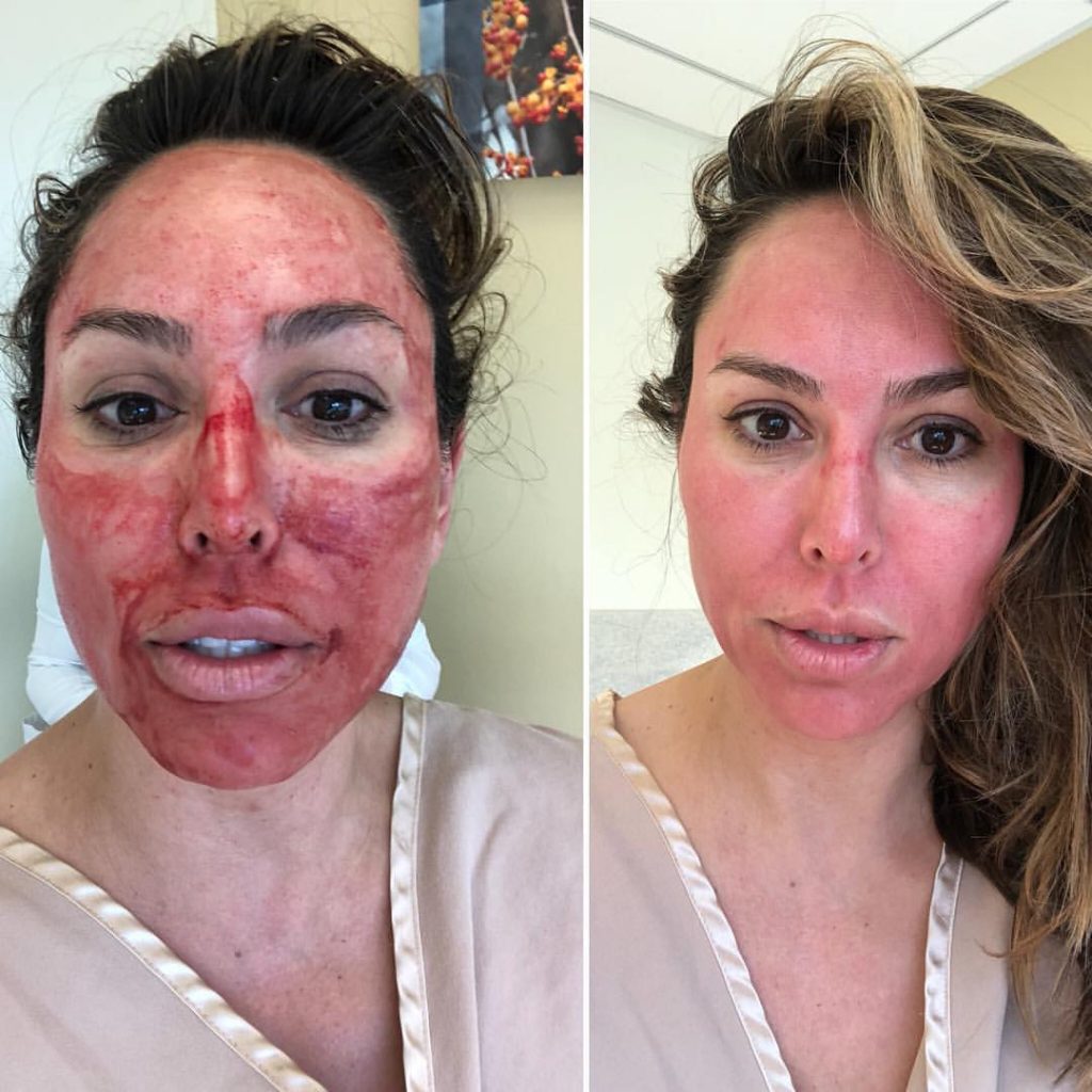 Kelly Dodd-vampire-facial-micro-needling