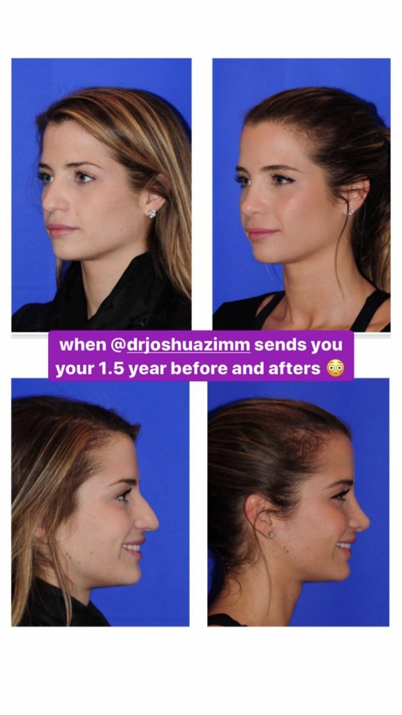 Naomie Olindo's nose job before and 1.5 years after surgery